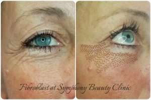 Fibroblast skin reduction eyelid