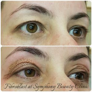 Fibroblast skin reduction upper eyelid