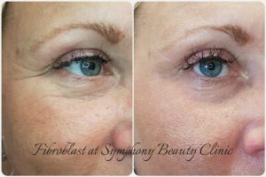 Fibroblast lower eyelid crease removal