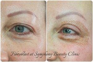 Fibroblast skin reduction upper eyelid