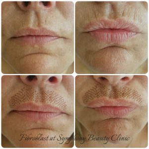 Fibroblast skin reduction upper lip