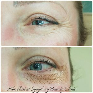 Fibroblast skin reduction lower eyelid