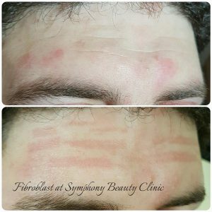 Fibroblast skin reduction frown lines