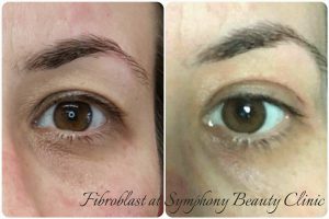 Fibroblast skin reduction upper eyelid